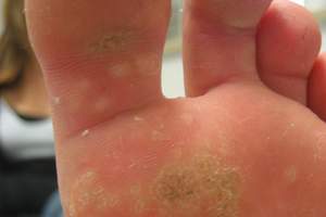 vindeca paraziții în litri warts foot nails